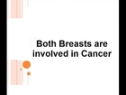 Both Breasts participate in Cancer Progression