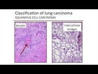 Advances in Diagnosing Lung Cancer
