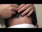 FUE Asian Hair Transplant Result Natural Hair Line Balding Frontal Hair Loss Dr. Diep mhtaclinic.com