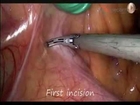 Hand Assisted Laparoscopic TME for Rectal cancer
