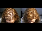 regrow hair treatment for women - how to regrow hair on bald spots