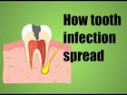 How tooth infection spread - Dental animation - Decay tooth