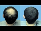 how to increase hair growth naturally for men - increase hair growth quickly
