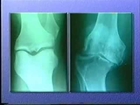 Arthritis knee pain, forever freedom FLP webm