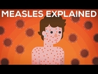 Measles Explained — Do You Really Need To Vaccinate?